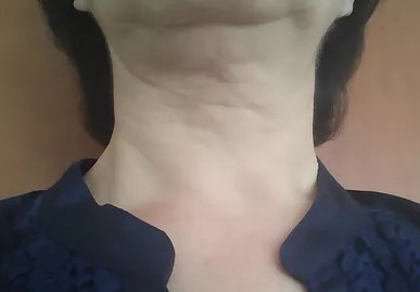 תמונה 2 לפני החדרת חוטי APTOS לאזור הצוואר